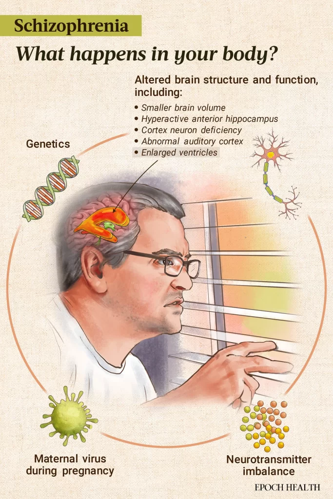 fisiopatologia-Schizophrenia_dr-jose-nasser-aquera